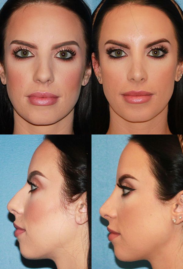 Liquid nose job Beverly Hills is actually a no-surgery rhinoplasty which will improve the look of your nose area